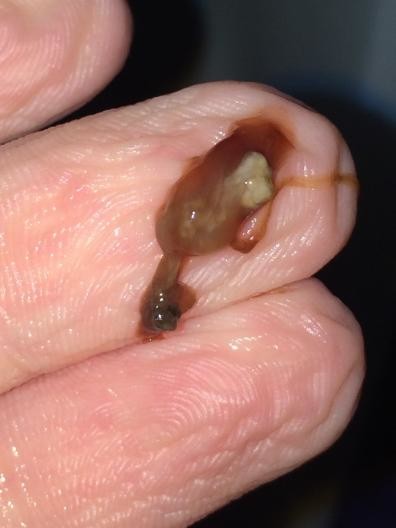 Does This Look Like An Early Miscarriage Warning Somewhat Graphic Pics