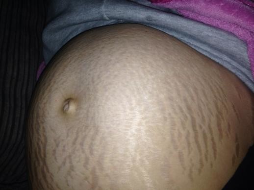 Stretch Marks