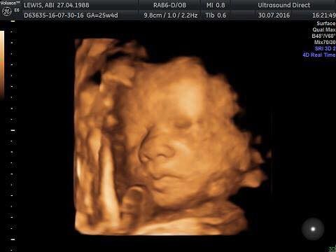 Anyone Got 4d Scan Pics From 25 Weeks