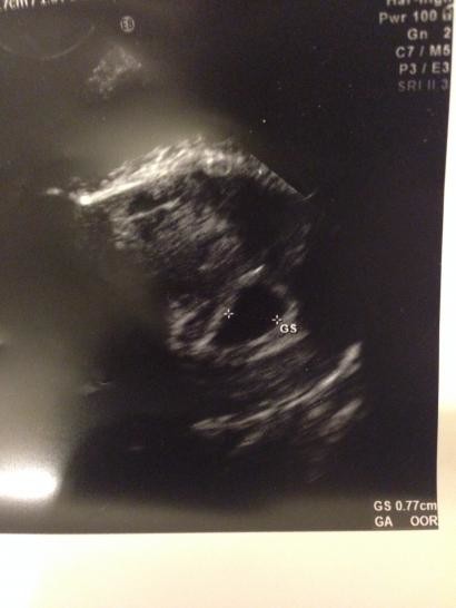 6 Week 3 Days Scan Showed Nothing But Small Gestational Sac