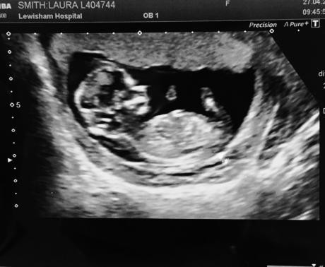 Weeks pictures 12 at baby boy scan Post confirmed