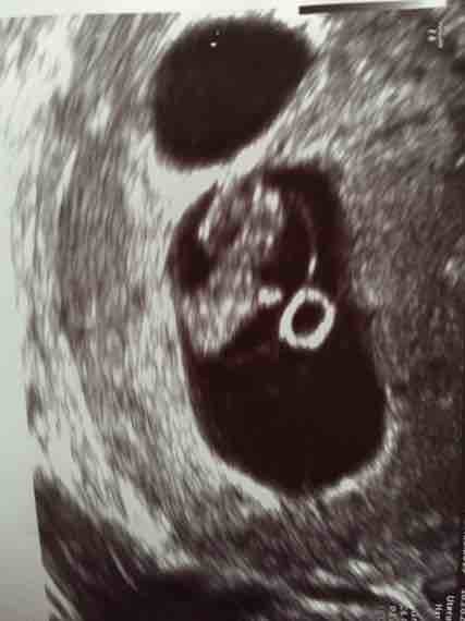 Empty ultrasound sac uterus tilted 6 weeks