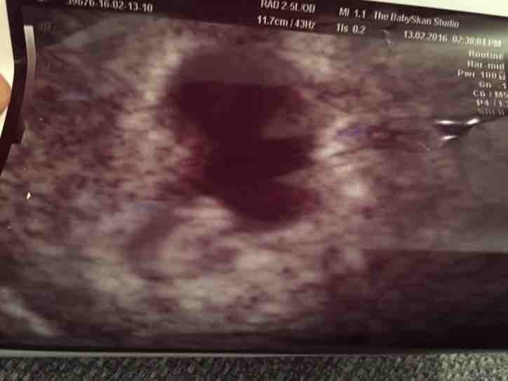 6weeks-pregnant-scan-shows-gestational-sac-and-yolk-sac-but-no-baby