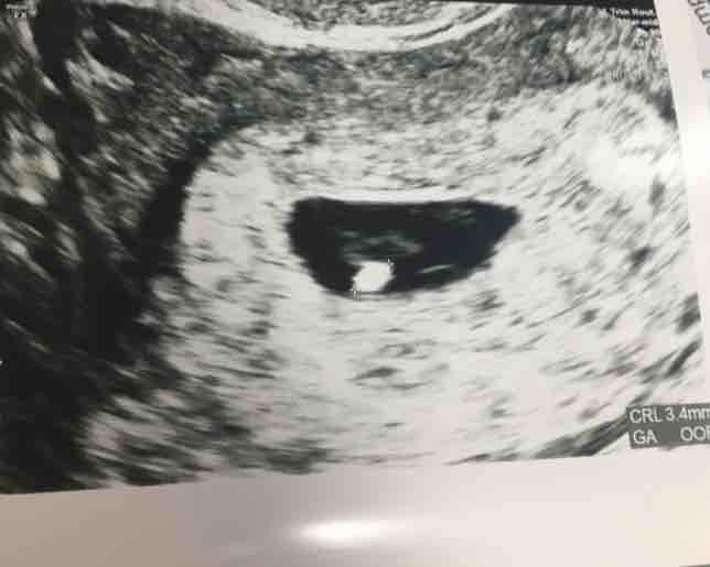 Heartbeat pregnant no embryo &