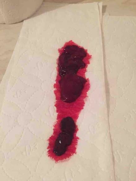 Bright Red Blood And Clots During Pregnancy