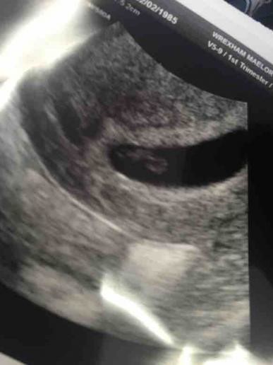 5.5 weeks ultrasound pics please