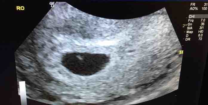 6-week-1-day-ultrasound-13mm-sac-no-fetal-pole-no-yolk-sac-could-it