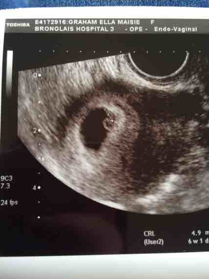 Ultrasound is 7 kind done weeks what at of 7 Weeks