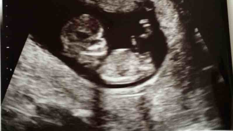 12 week scan nub theory?