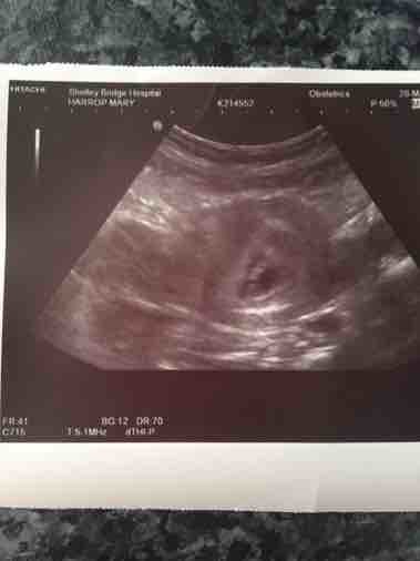 Twins 7 week ultrasound Can Twins