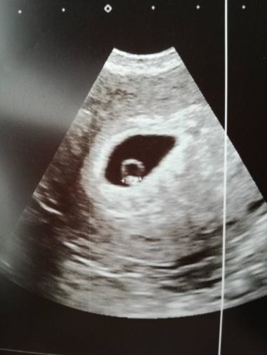 Near me baby scan 3D/4D ultrasounds