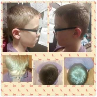 plagiocephaly 3 year old