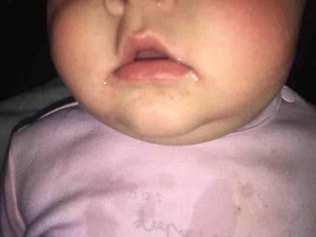 Hand Foot And Mouth Panicking