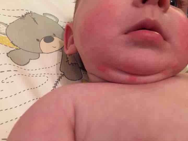 sudocrem for drool rash