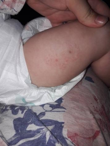 Rash after 4 month vaccine