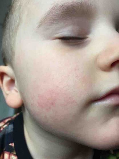 Toddler Rash Pictures Nursery Sent Him Home