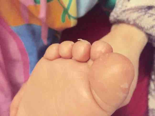 Flaky Skin Blisters On Toddler S Feet