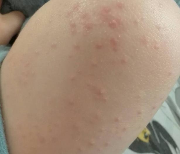 viral-rash-or-not