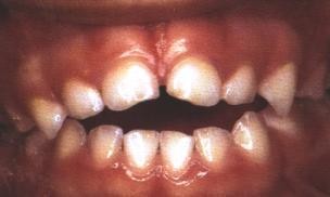 soother teeth