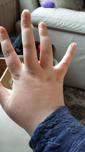 Has Anyone Had A Sprained Finger I Can Have Some Advice Please