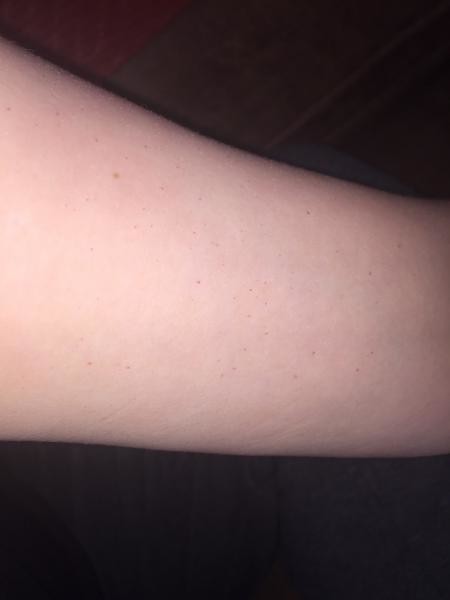 Why Do I Have Tiny Red Dots On My Arm