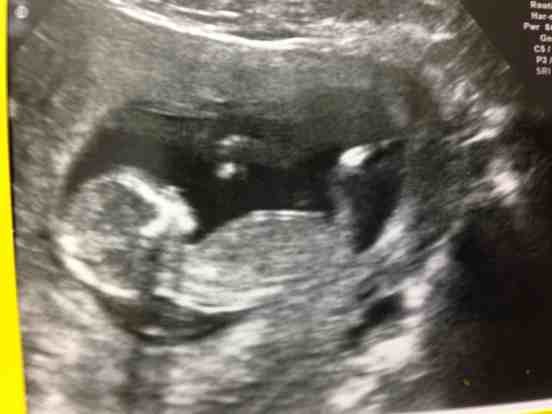 Confirmation scan gender What to