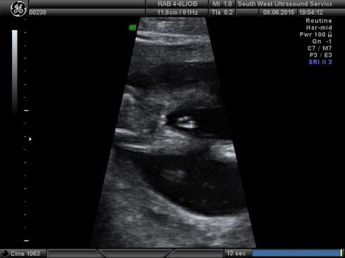 Please Help 15 Week 5 Day Gender Scan X