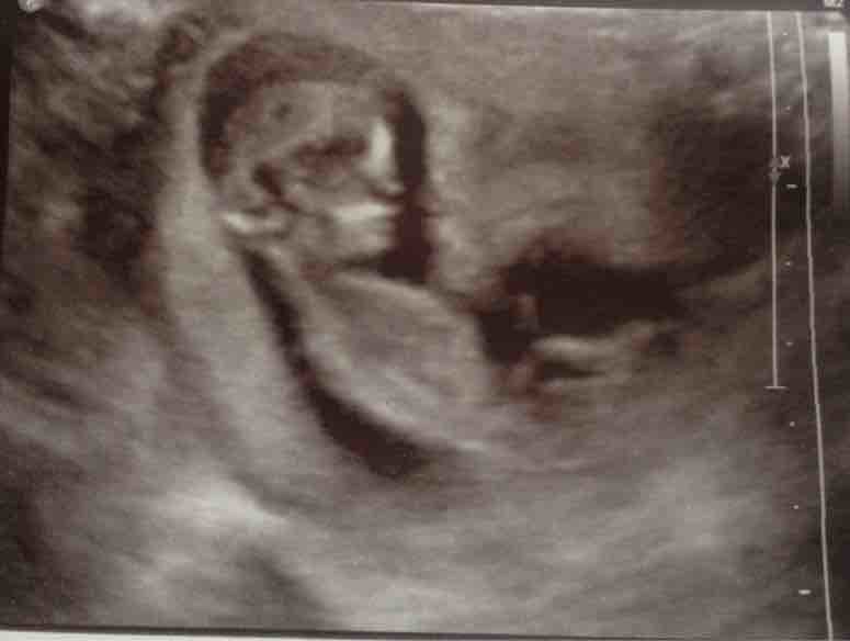 Confirmed 12 Week Scan Pics Only Please Need To Compare