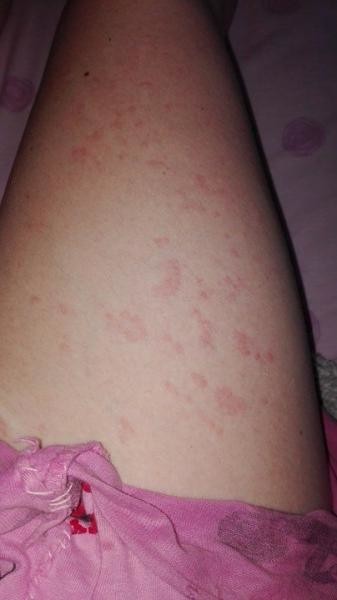 Rash Early Pregnancy Toxoplasmosis