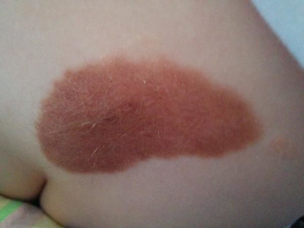 Hairy Nevus birthmark
