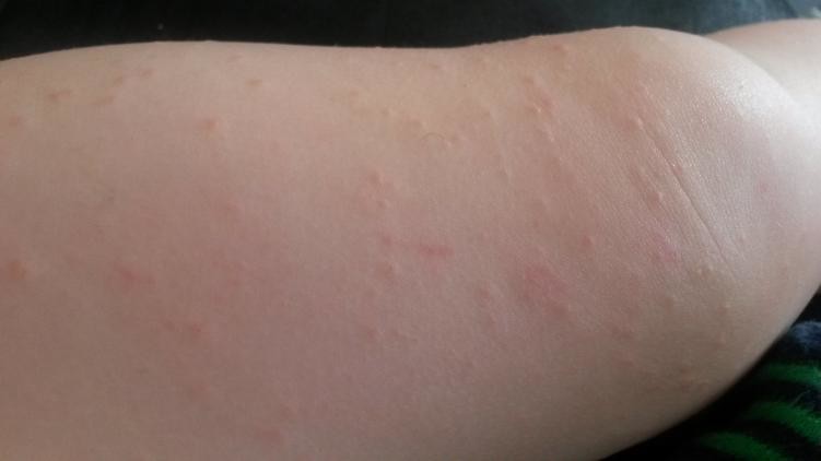 Odd Rash On Toddlerdrs Stumped