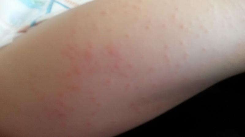 Red Bumpy Rash On Toddler Back