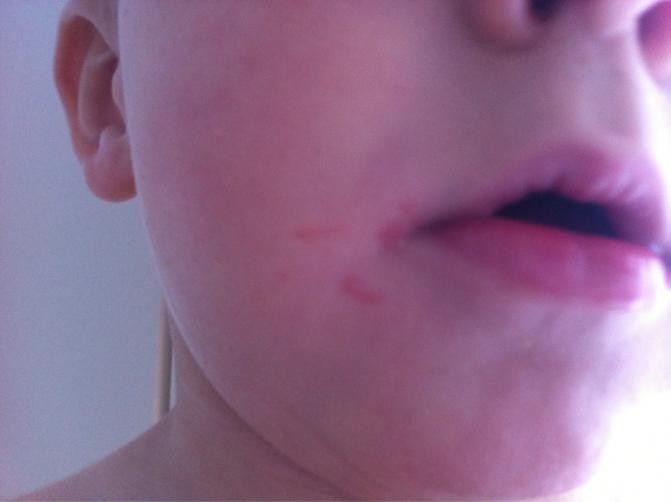 Is This Chicken Pox Or Impetigo Netmums