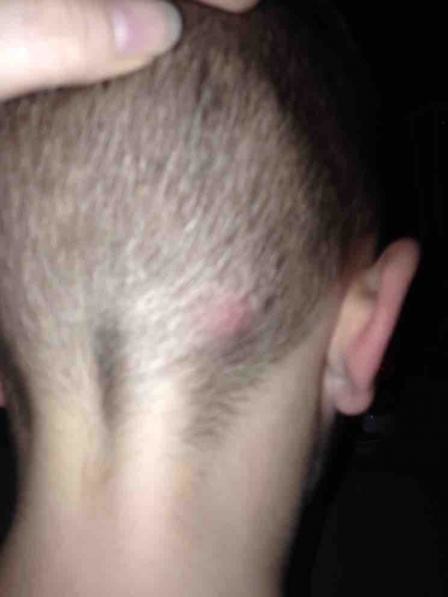 Lump On 5 Year Old Head Netmums