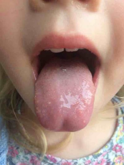 white-spots-on-tongue-and-lips-toddler-lipstutorial