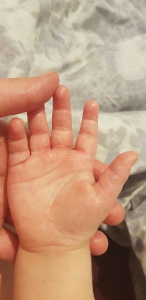 weride-rash-on-palm-of-2-year-old