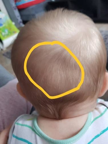 Indent On 7 Month Olds Head