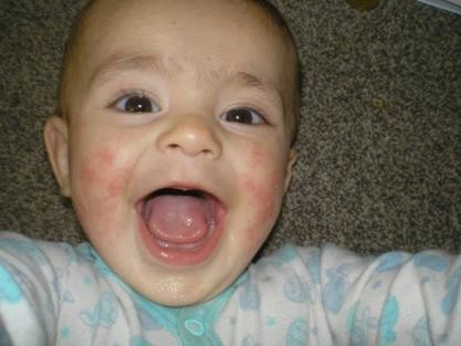 Dead Sea Salts For Eczema