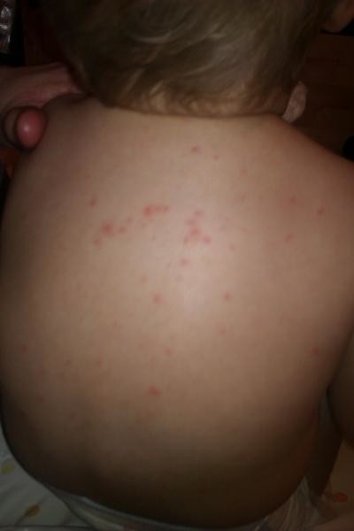 what-is-this-rash-spots-in-toddler