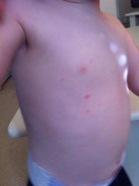 Is This Chicken Pox Picture Help Please Netmums