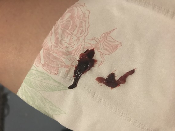 Does This Look Like An Early Miscarriage Would Be 4w5d Does This Look Like An Early Miscarriage Would Be 4w5d