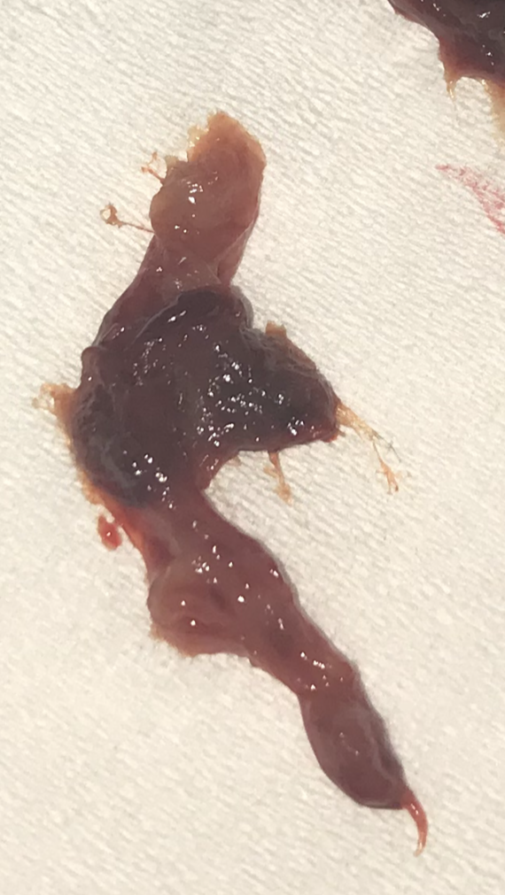 Does This Look Like An Early Miscarriage Would Be 4w5d Does This Look Like An Early Miscarriage Would Be 4w5d