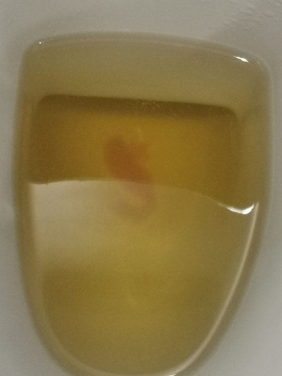 5 Week Miscarriage 5 Week Miscarriage