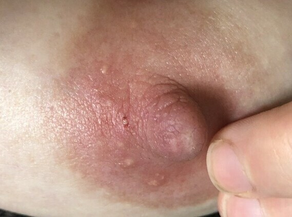 White lump on nipple