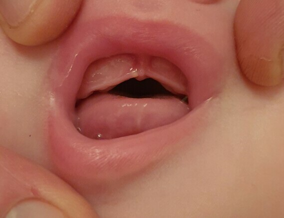 tooth or epstein pearl