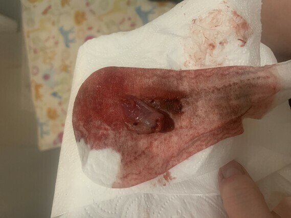 Is this an early miscarriage? GRAPHIC PIC