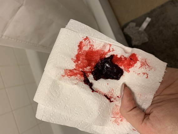 Possible Miscarriage Warning Tmi Picture Possible Miscarriage Warning Tmi Picture