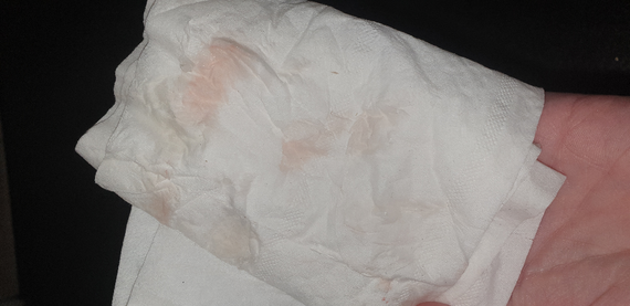 Implantation Bleeding