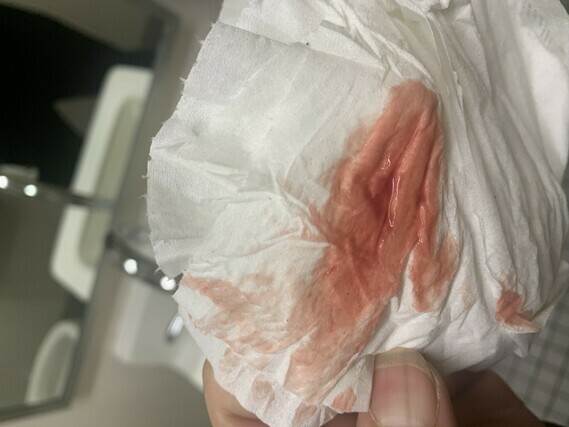 Pics Bleeding At 5 Weeks 4 Days Miscarriage