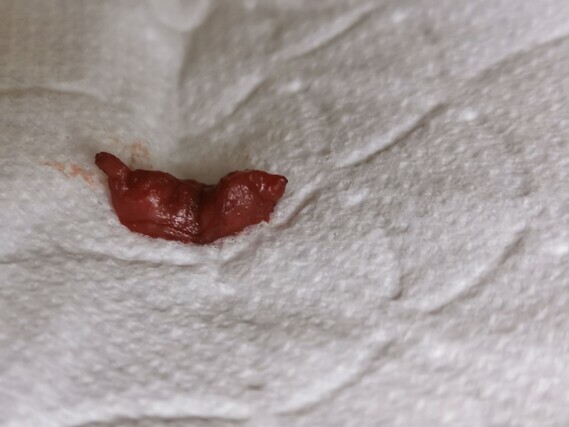 Warning Pictures Is This A Very Early Miscarriage